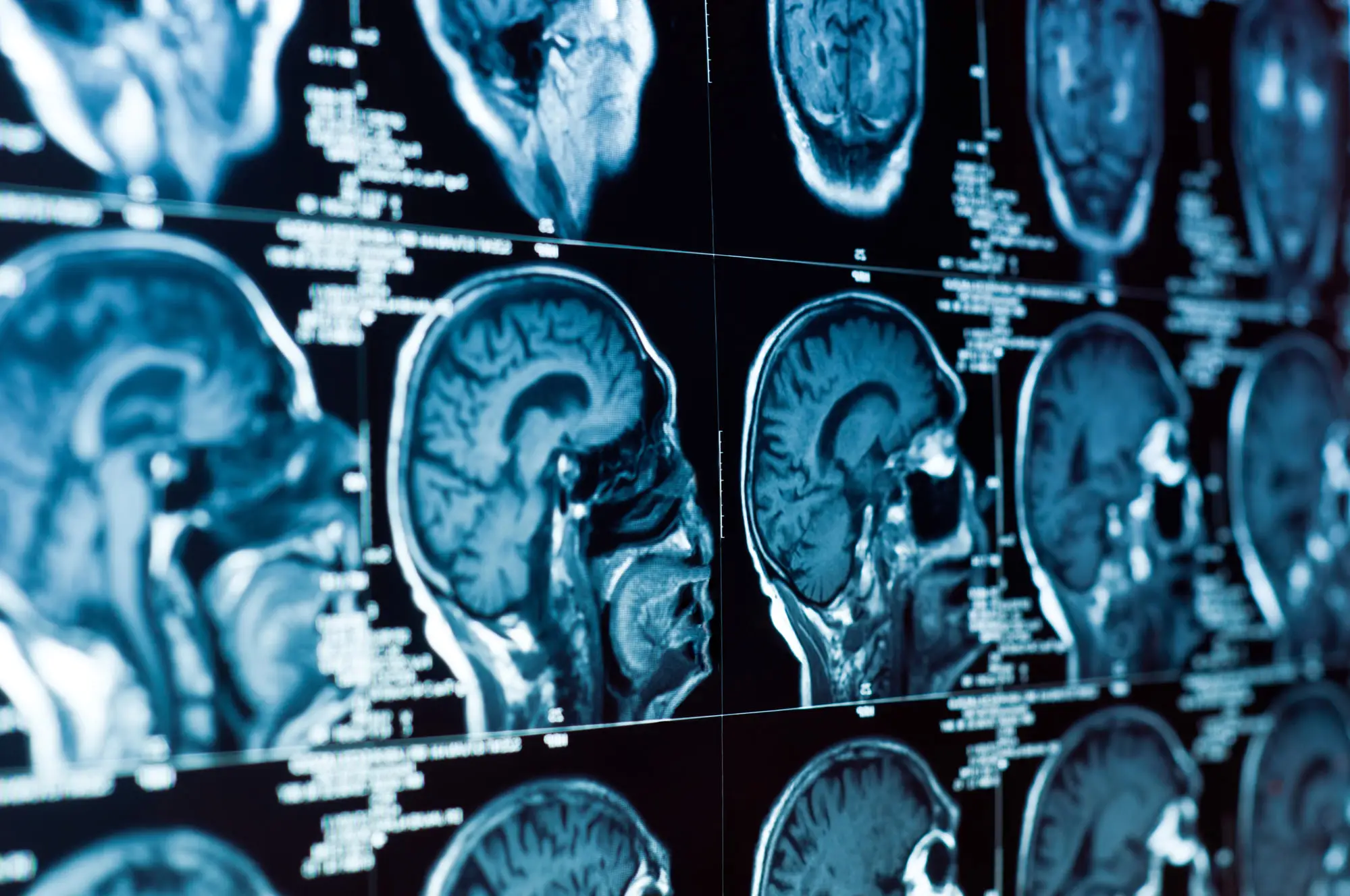 Traumatic Brain Injury due to gravity-related risks such as falling injuries Traumatic Brain Injury due to gravity-related risks such as falling injuries