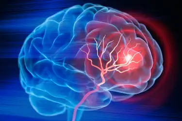 stroke in car accident case stroke in car accident case